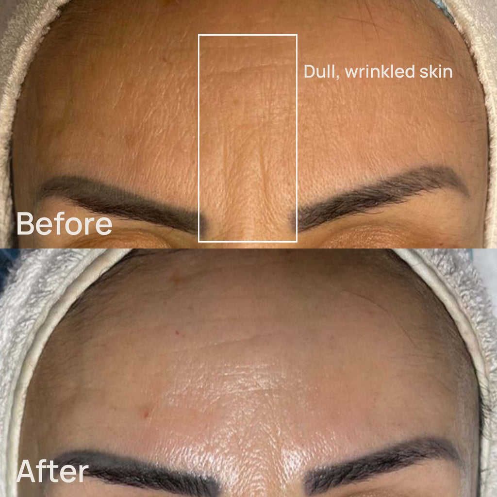 Mediplorer CO2 Gel Mask (6 packs)