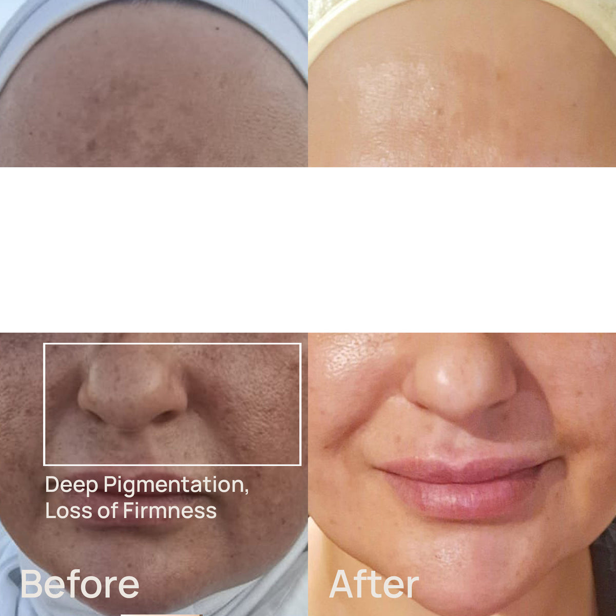 Mediplorer CO2 Gel Mask Premium (6 pack)